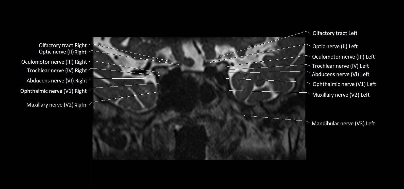 Cranial nerve cross sectional anatomy coronal 3T MRI image 23.webp